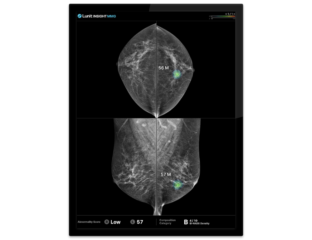 RSNA 2025 LP_MMG & DBT
